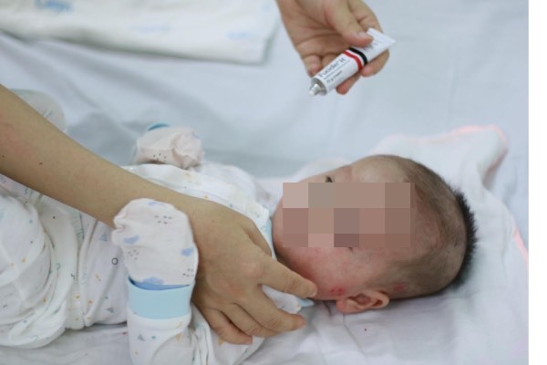 Trẻ 8 tháng tuổi da đóng vảy, chảy dịch vì cha mẹ tự chữa chàm