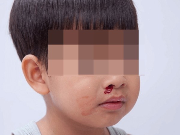 Panicked because the child had nosebleeds and sweated his shirt when infected with Covid-19