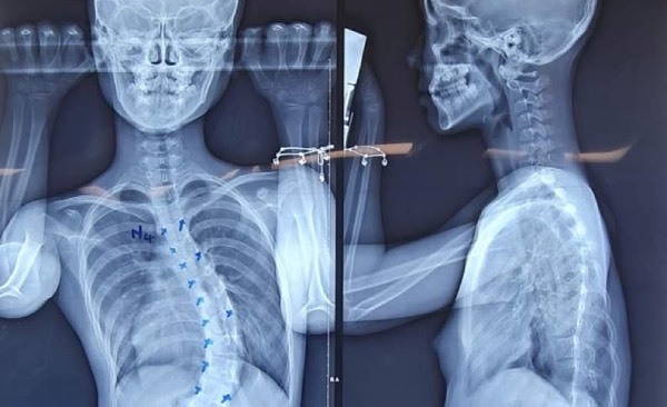 32 screws to tighten vertical and horizontal bars to straighten the spine for 11-year-old girls