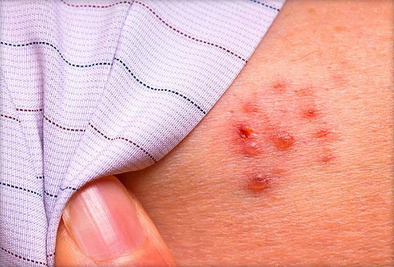 The most terrible complication of shingles