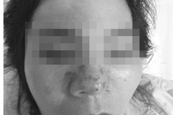 Needle broken right in the face, blind eyes after injecting cheap beauty filler just…