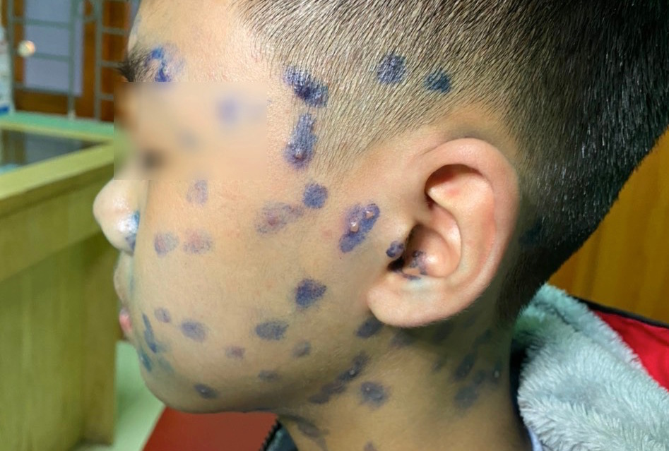 The rash is full of people after being infected with Coronavirus, thinking that after Covid-19 has become an extremely contagious chickenpox disease