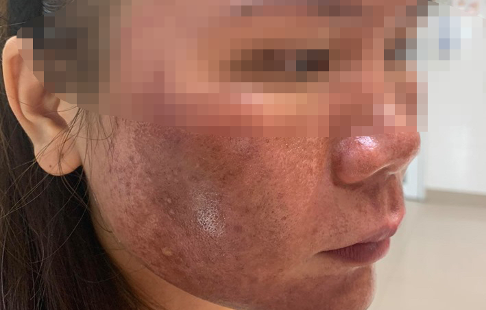 Anaphylaxis due to skin peeling cream bought online, dermatologists warn of things women must remember if they want to improve their skin