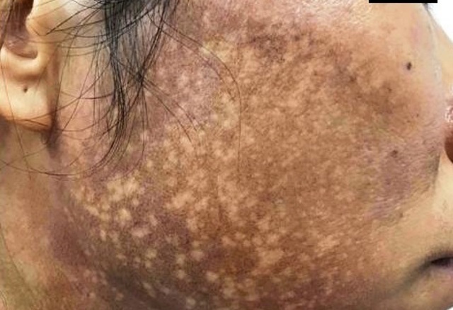 Grade III anaphylaxis due to skin peeling creams bought online, dermatologists warn of what women want to whiten their skin without complications