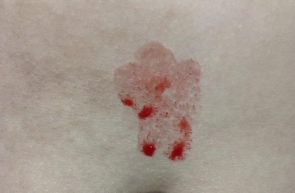 10-year-old girl with “blood sweat” phenomenon