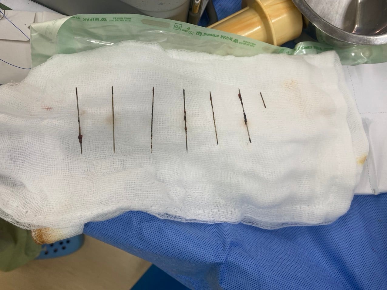 Take 7 needles in the chest of a 28-year-old woman