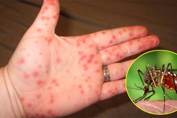 6 người tử vong vì sốt xuất huyết: Giai đoạn nào của bệnh nguy hiểm nhất