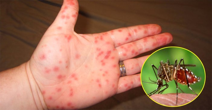 6 người tử vong vì sốt xuất huyết: Giai đoạn nào của bệnh nguy hiểm nhất