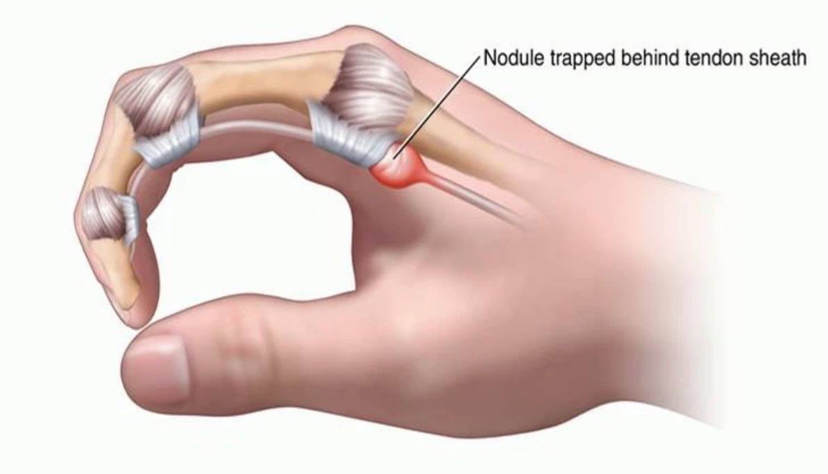 Sudden pain, patients with spring finger disease, who is susceptible to this disease?