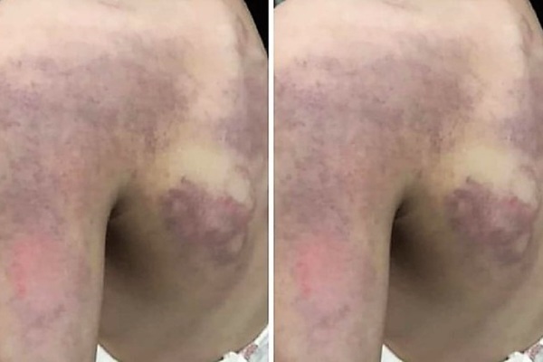 Temporarily suspending the teacher who beat the student with bruises, Nghe An Department of Education and Training spoke out