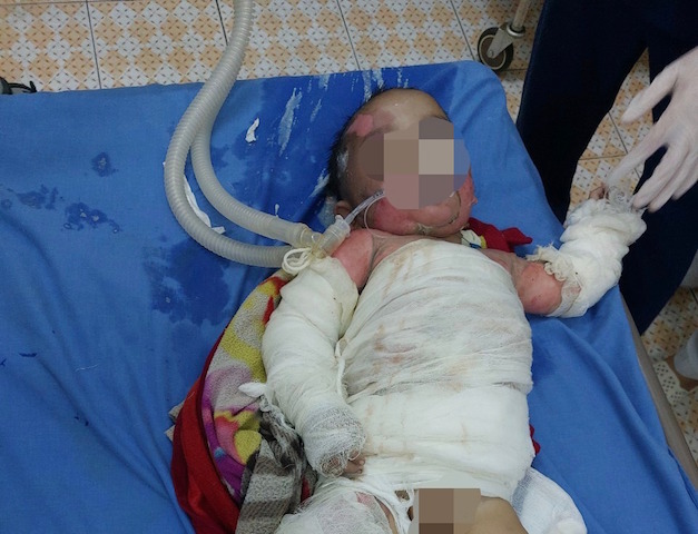 7-month-old baby fell into the fire, the area of ​​​​burns up to 40% of the body, the doctor warned of improper handling