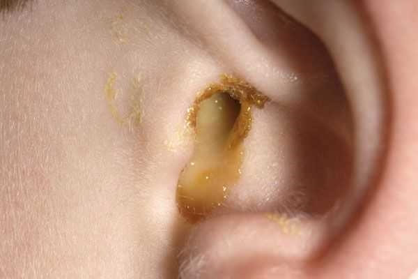Ignoring ear rot disease spreading to brain abscess