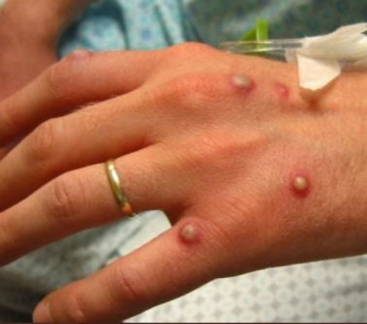 Monitoring and preventing smallpox at the border gate