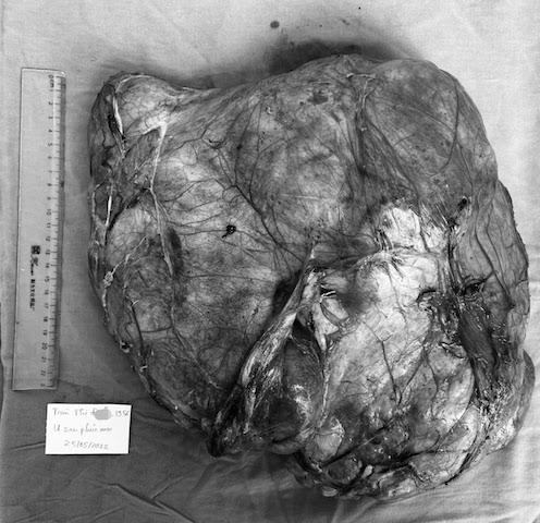 The “huge” tumor is up to 40 cm in diameter, occupying almost the entire woman’s abdomen