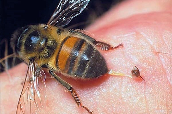 Nghệ An: Bé gái 18 tháng tuổi bị đàn ong mật đốt gần 50 nốt