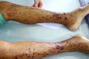 Ban xuất huyết mọc kín 2 cẳng chân, người đàn ông mắc bệnh chưa rõ nguyên nhân, không có thuốc điều trị đặc hiệu