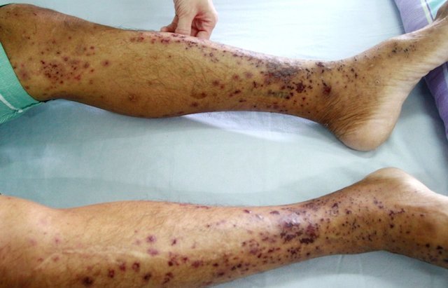 Ban xuất huyết mọc kín 2 cẳng chân, người đàn ông mắc bệnh chưa rõ nguyên nhân, không có thuốc điều trị đặc hiệu