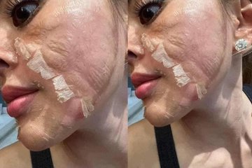 'Toang' cả mặt vì tự lột da làm đẹp, chi 70 triệu để sửa cũng khó phục hồi