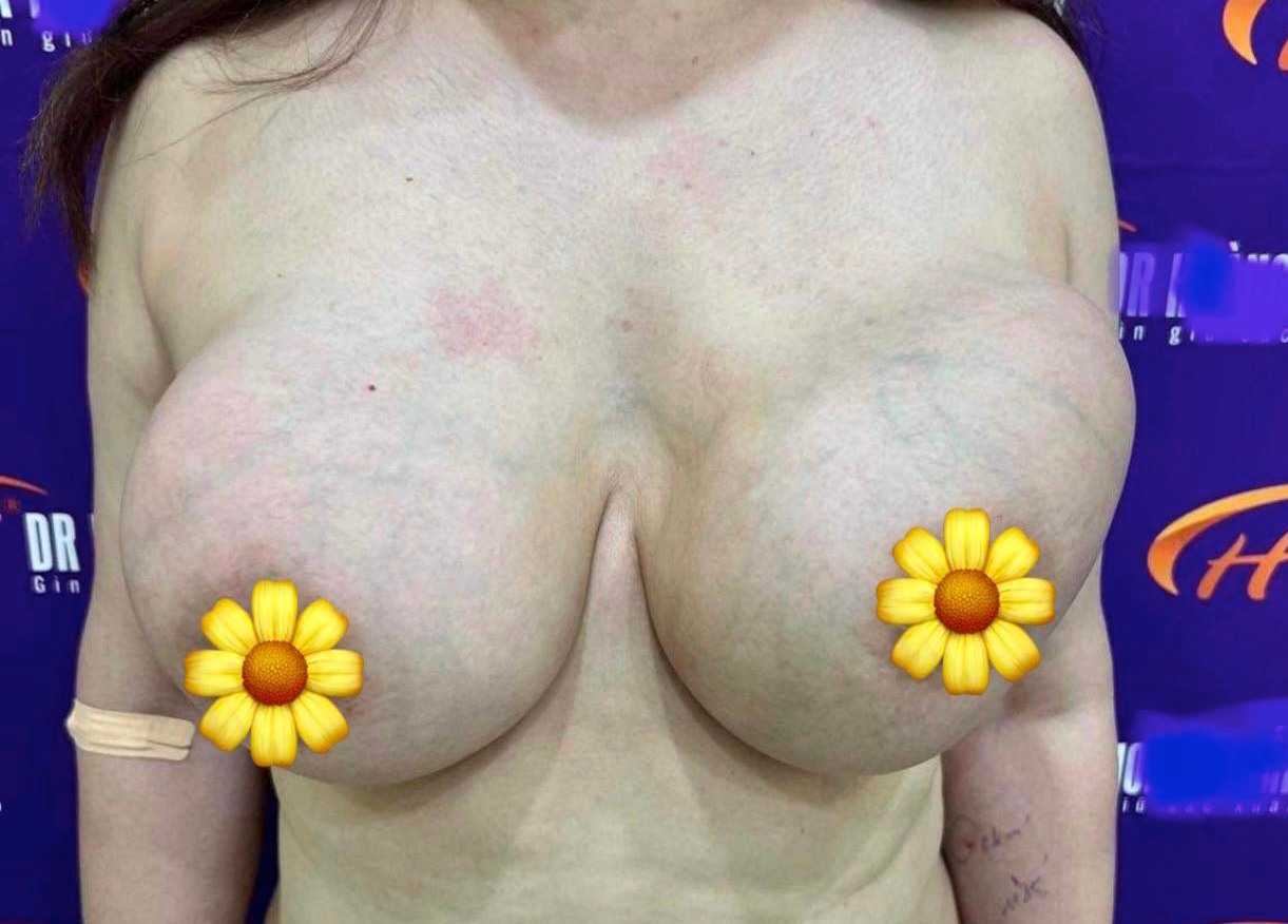 Nữ Việt Kiều ôm ngực khổng lồ biến dạng như muốn 'nổ' về nước cầu cứu bác sĩ