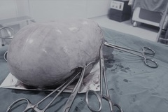 Nghệ An: Cắt bỏ thành công khối u xơ tử cung ‘khủng’, nặng gần 2kg cho nữ bệnh nhân 40 tuổi