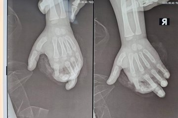 Cho tay vào máy xay sinh tố đang hoạt động, bé gái 4 tuổi bị đứt gần rời ngón 2 tay phải