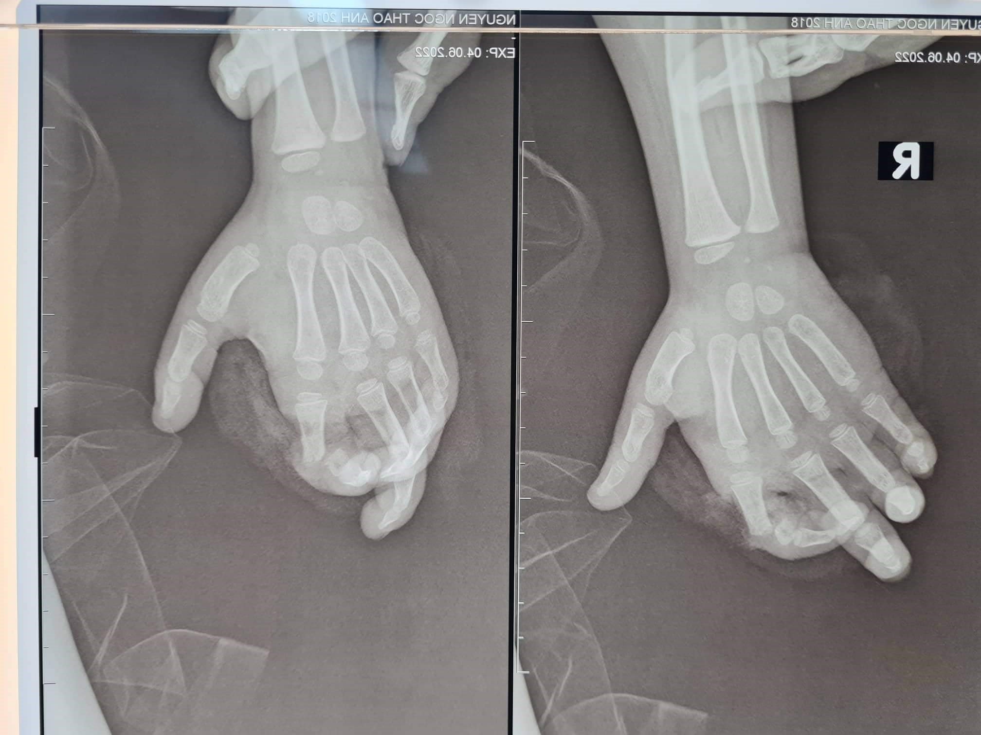 Cho tay vào máy xay sinh tố đang hoạt động, bé gái 4 tuổi bị đứt gần rời ngón 2 tay phải