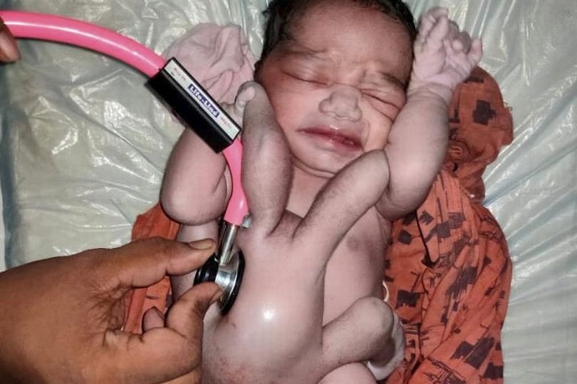 Em bé Ấn Độ sinh ra với 4 chân 4 tay, được gọi là ‘điều kỳ diệu của tự nhiên’