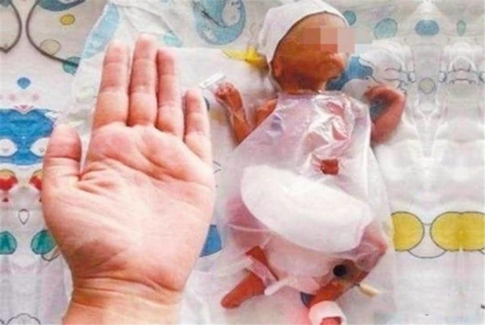 Hình ảnh xinh đẹp sau 14 năm của cô bé nhỏ nhất thế giới khi sinh ra chỉ 260 gam