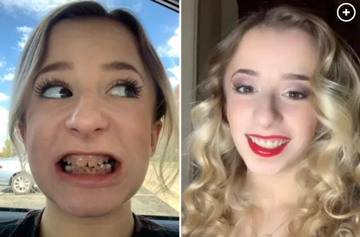 Kỳ lạ cô gái có hàm răng trong suốt, bị gọi là 'hàm răng cá mập'
