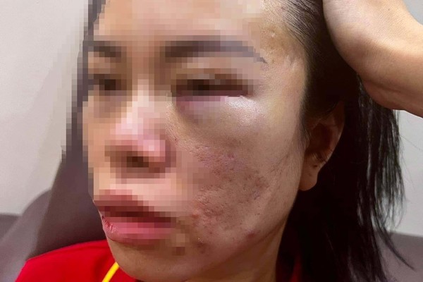 Người phụ nữ 'tố' chồng cũ bắt nhốt trên ô tô, đánh đập hơn 1 ngày: Công an quận vào cuộc